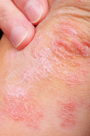 Kinds Of Skin Diseases