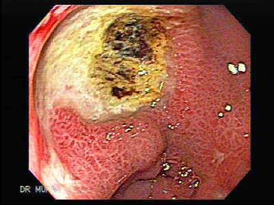 Kinds Of Ulcers