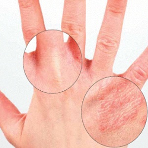 papilloma on hands